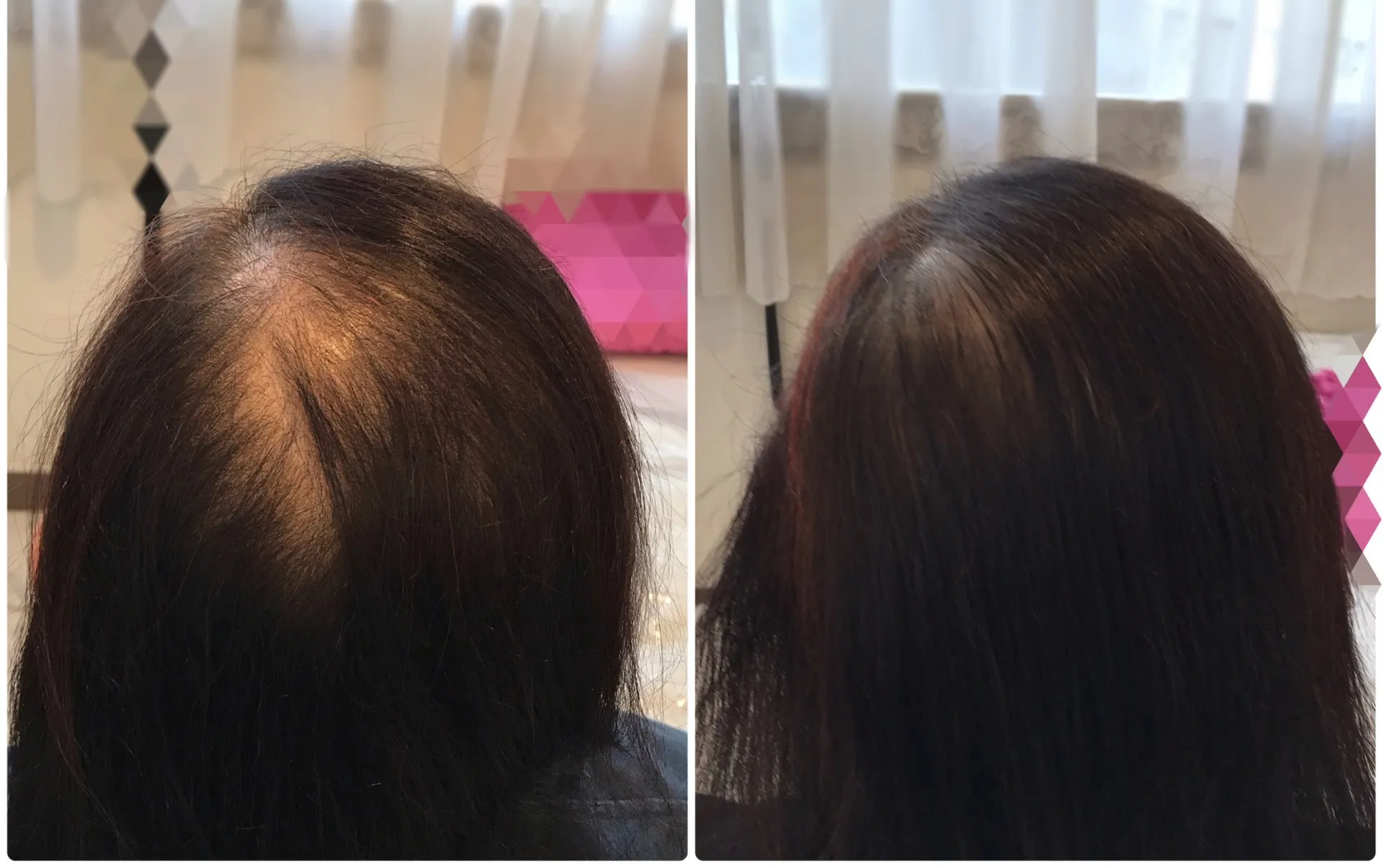 頭髪育毛促進・エクソソーム