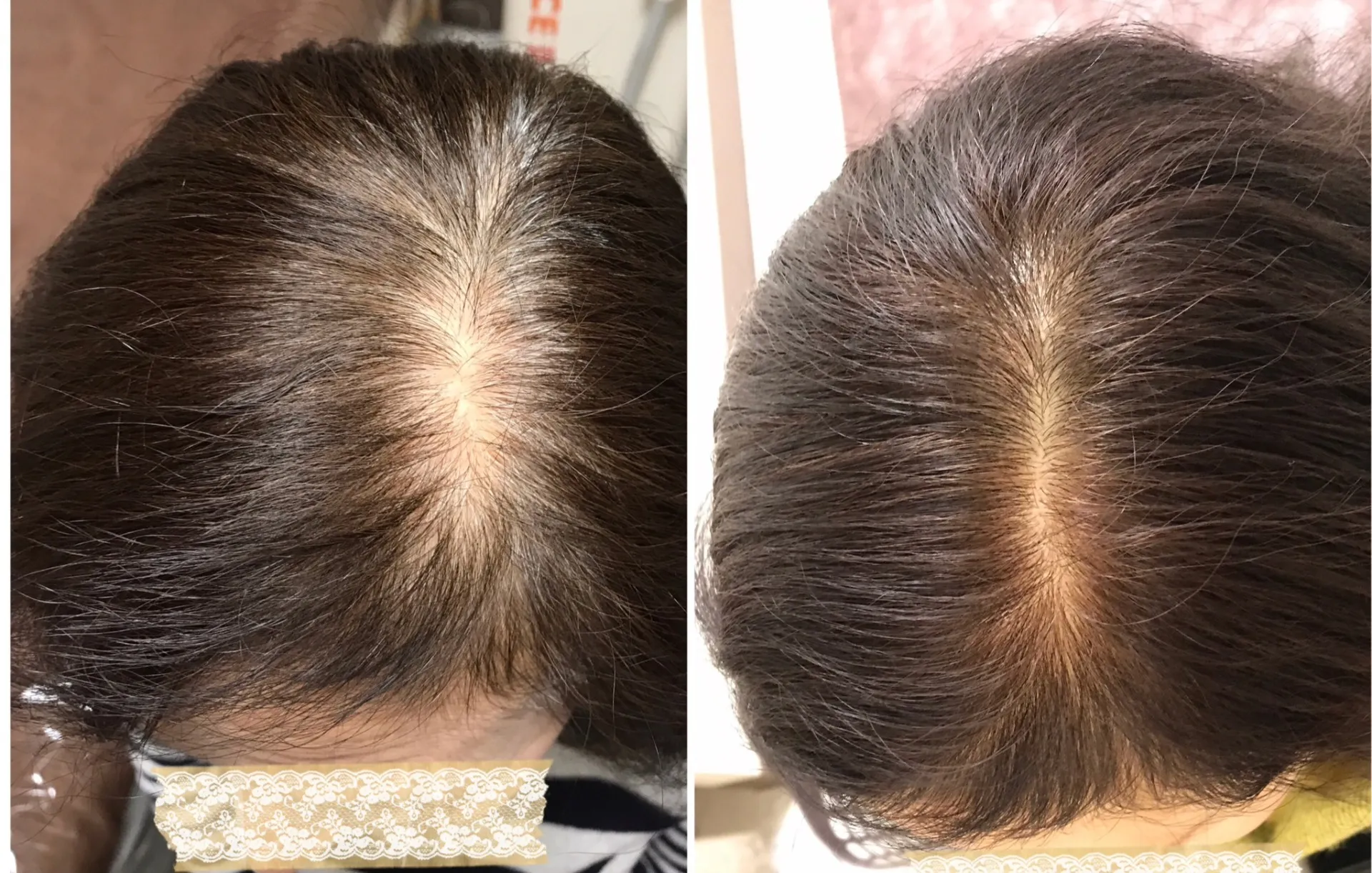 頭髪育毛促進・エクソソーム